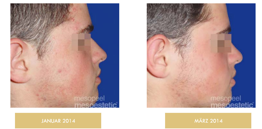 aufnahmen vor und nach der 3. Behandlung acne peel system zurich